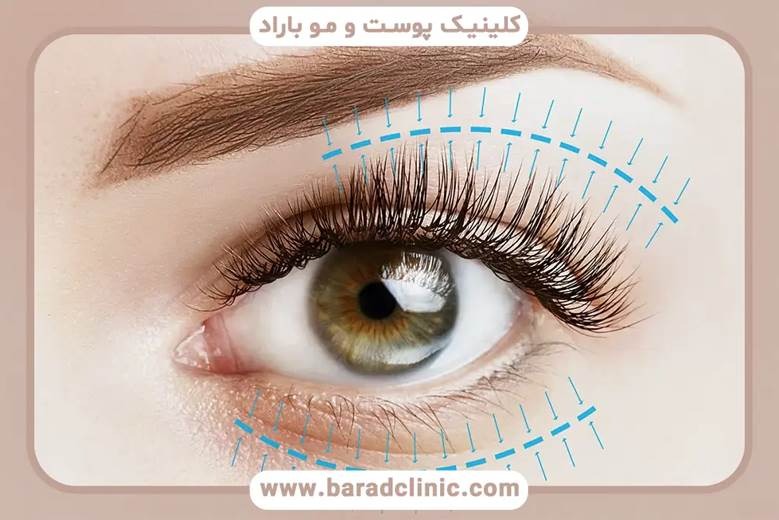 راهنمای کامل مراحل بلفاروپلاستی